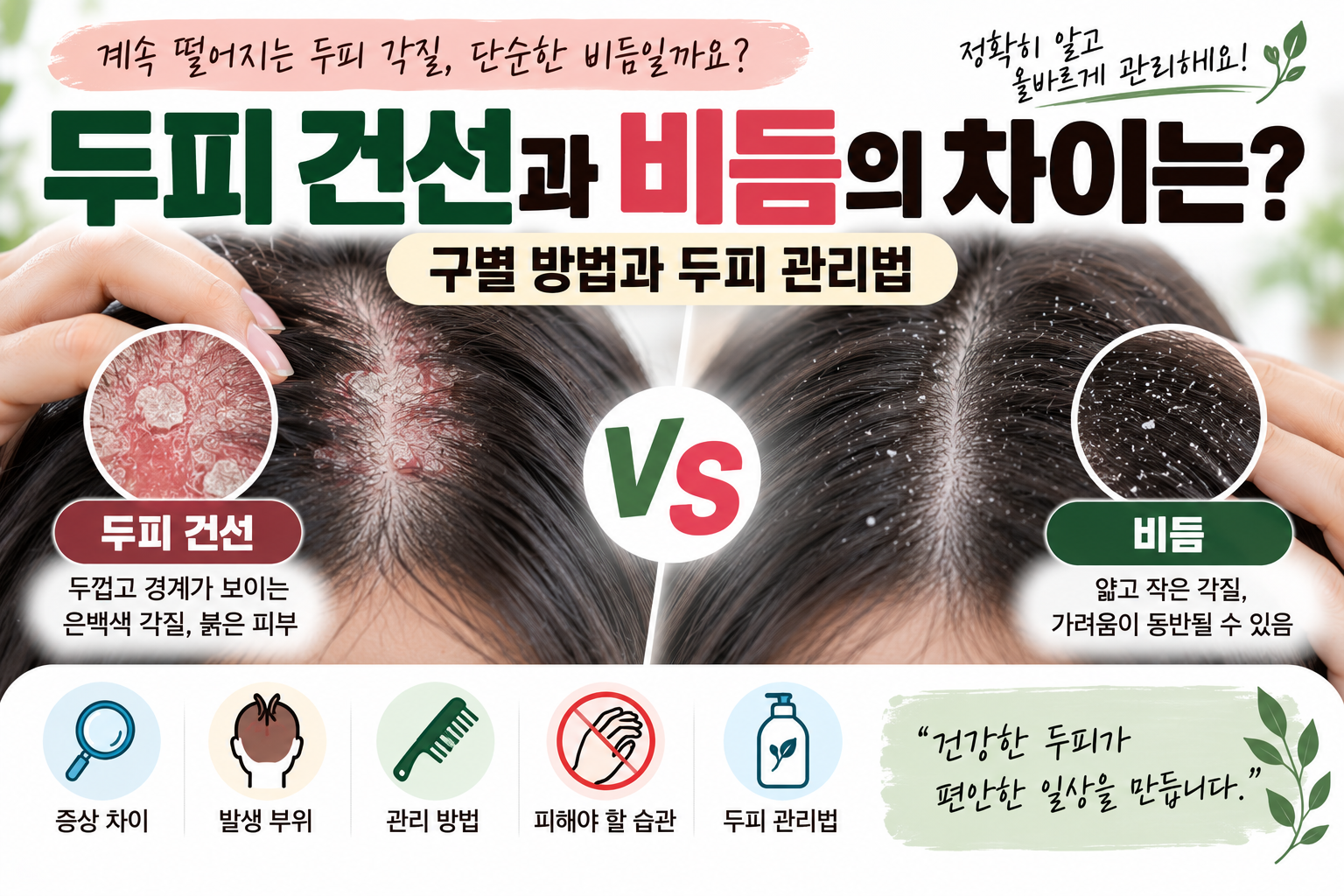 두피건선과 비듬의 차이
