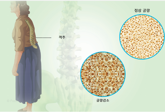 척추 의 정상 골량과, 골량 감소로 인한 골다공증의 골량