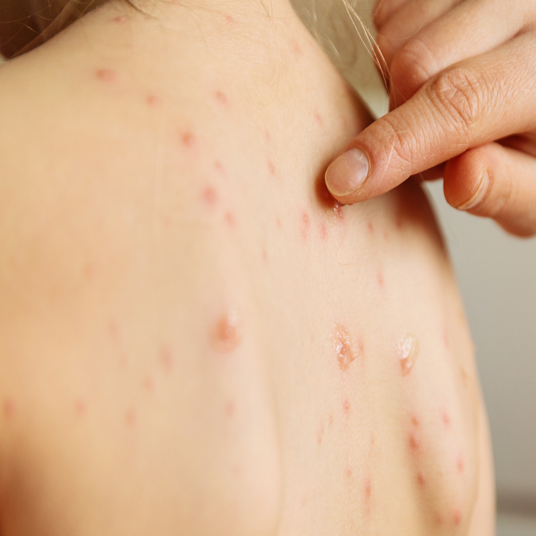 대상포진 단계별 치료법 (초기, 진행기, 회복기)