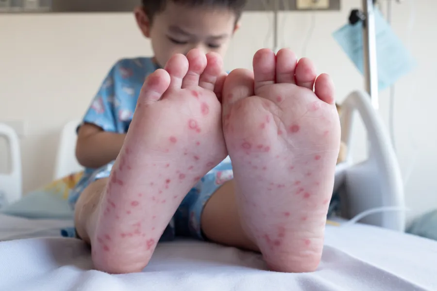 수족구 초기 증상 어른 감염 격리기간 예방 치료 완전 가이드_4