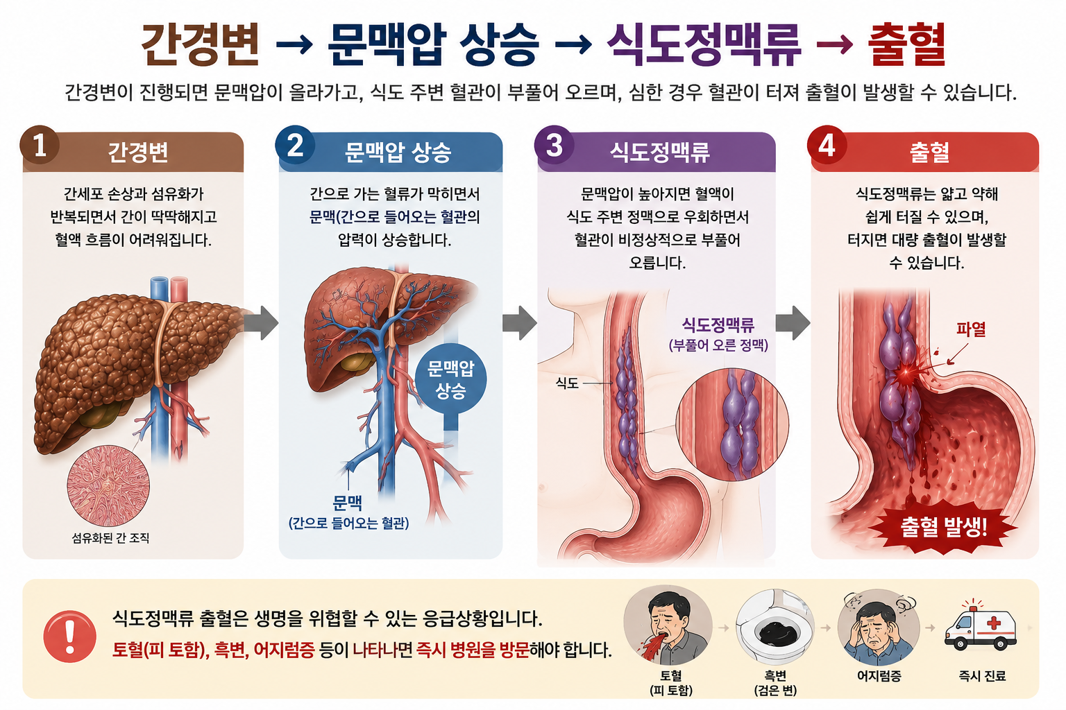 간경변이 진행되면서 문맥압 상승, 식도정맥류 형성, 출혈까지 이어지는 과정을 단계별로 설명한 의료 인포그래픽 이미지