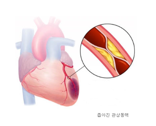 협심증, 갑작스런 가슴 통증! 원인과 치료 방법