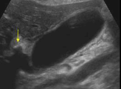 급성 담낭염 (Acute cholecystitis)