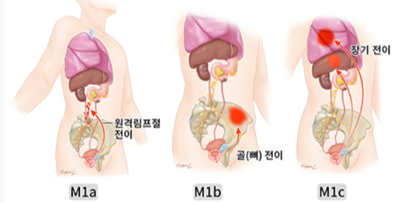 전립선암의 M병기 그림