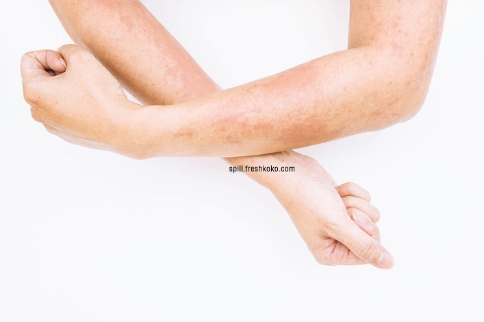 피부암 초기증상