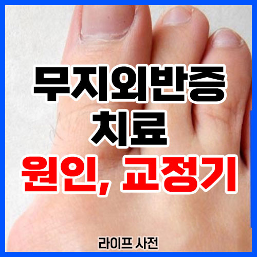무지외반증 치료