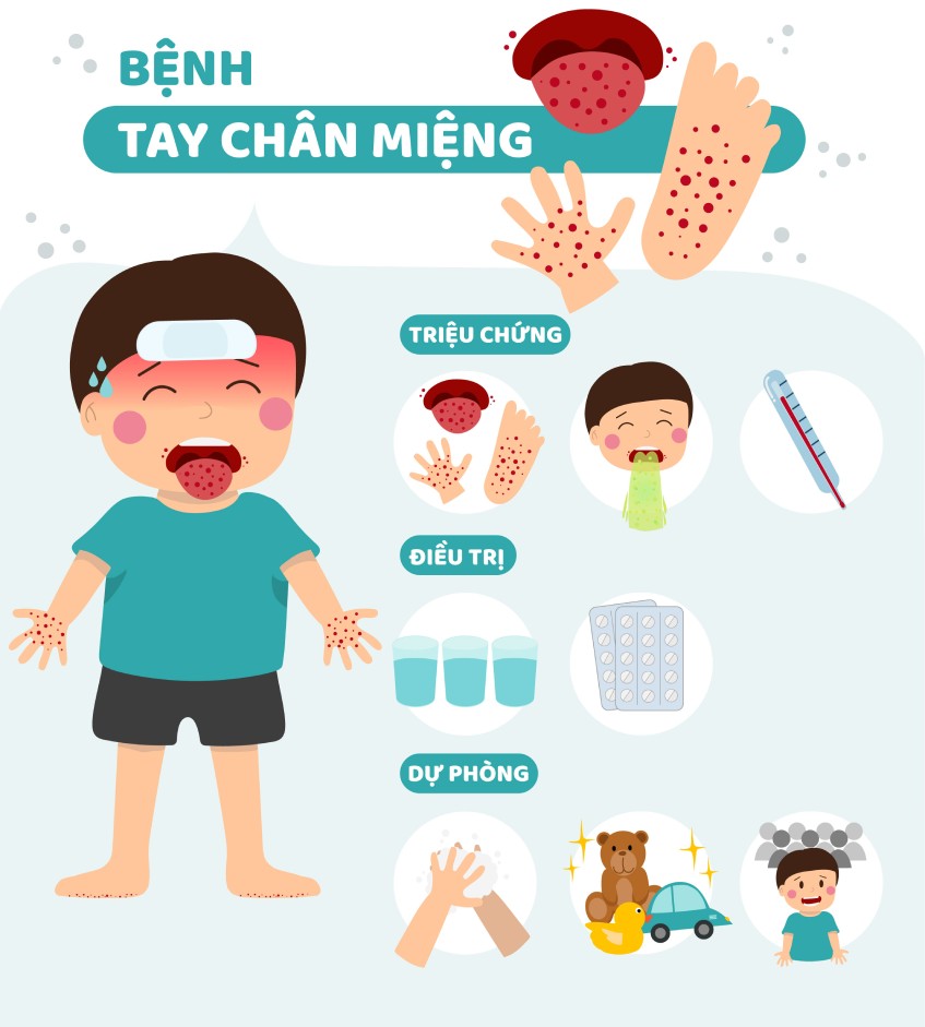 수족구병에 대한 안내
