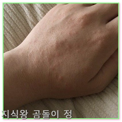 손등 좁쌀 두드러기 피부장벽 회복과 보습 꿀팁4