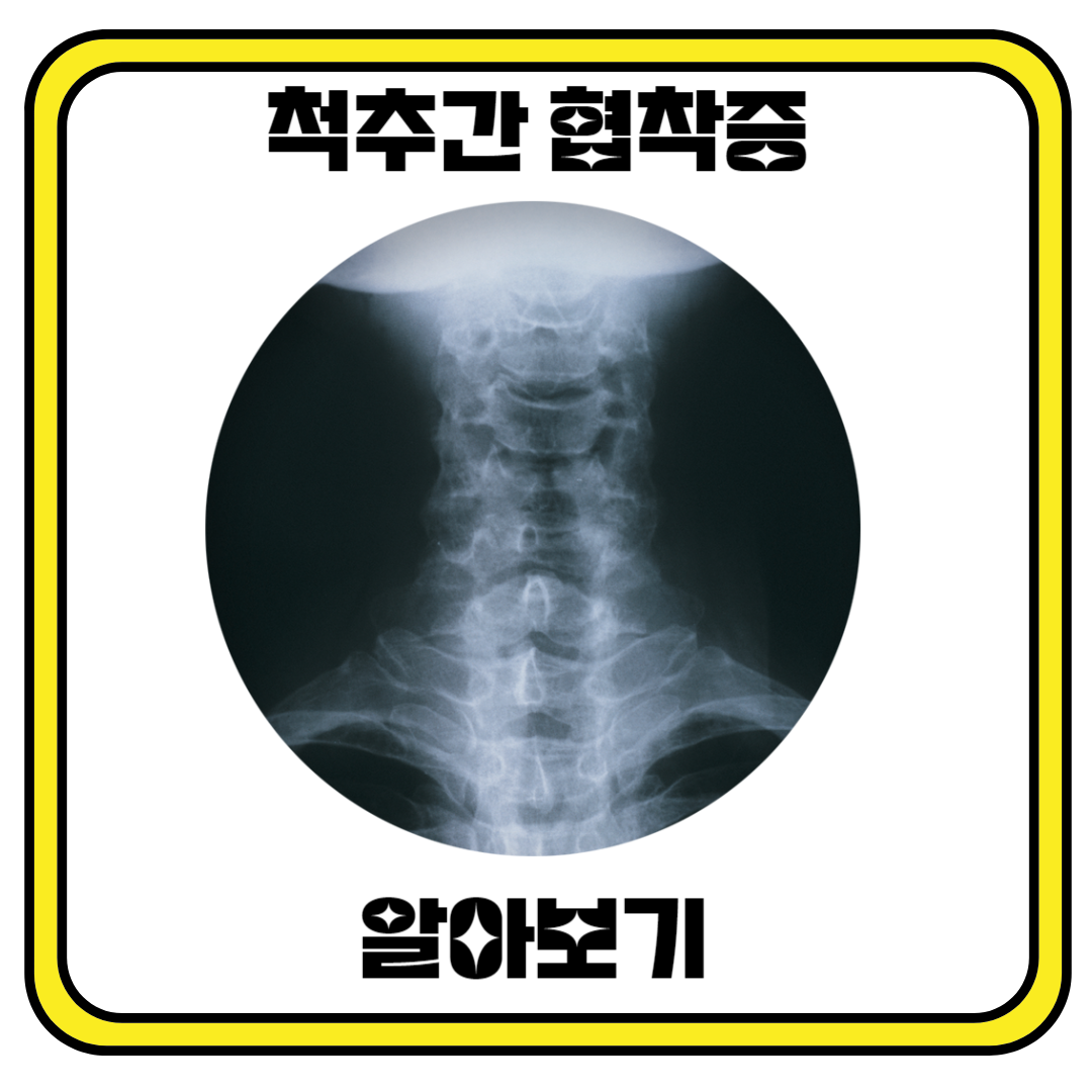 척추간 협창증