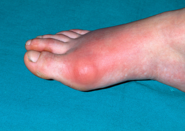 통풍의 원인과예방