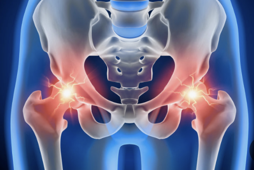 고관절 통증, 수술 없이 이렇게 나았습니다