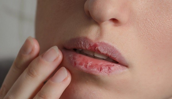 입술이 붓는 이유