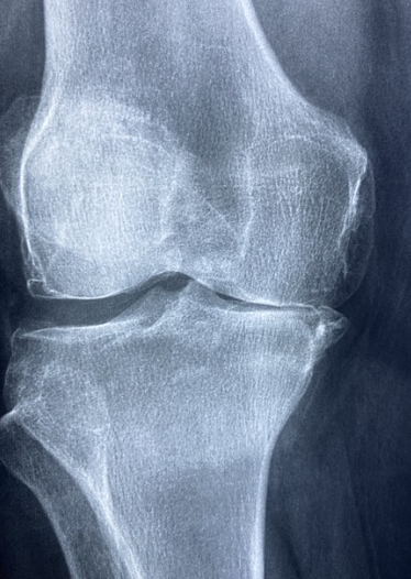 무릎관절 엑스레이