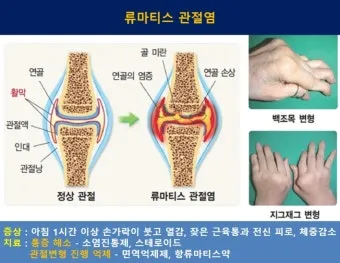 효과적인 류마티스 관절염 치료제 추천 약물 비교 가이드 2025 최신판_5