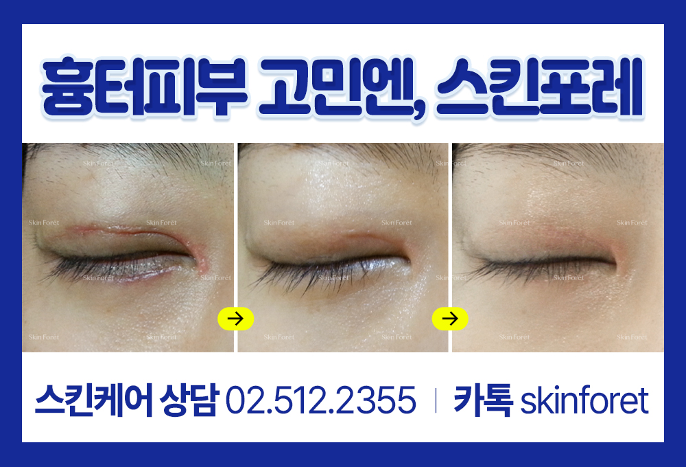 앞트임 후 눈가에 남은 쌍꺼풀흉터 관리 예시 이미지