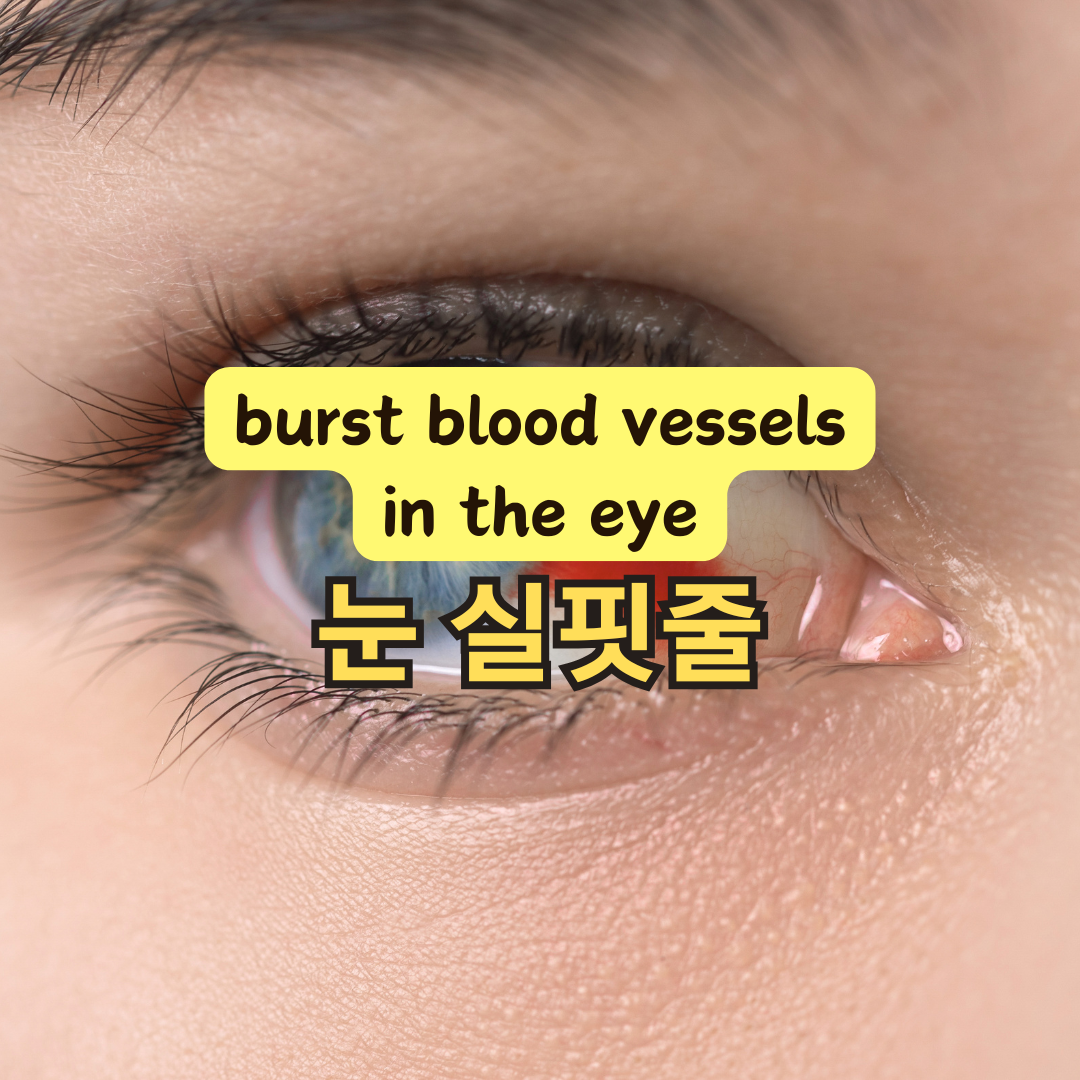 눈 실핏줄 터짐 원인과 결막하 출혈 예방법