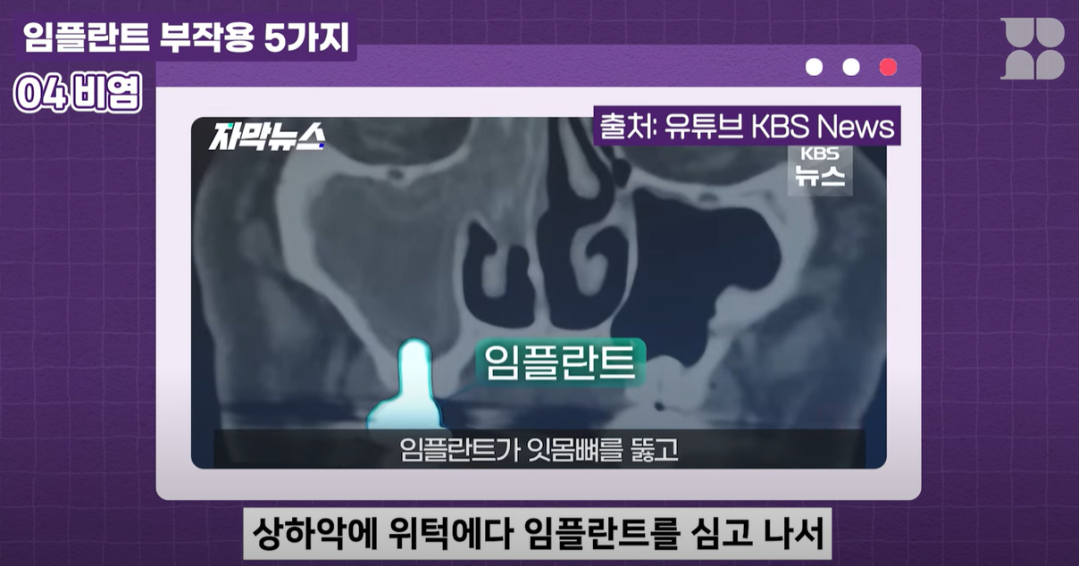 임플란트가 상악동으로 뚫고 지나가서 생기는 현상