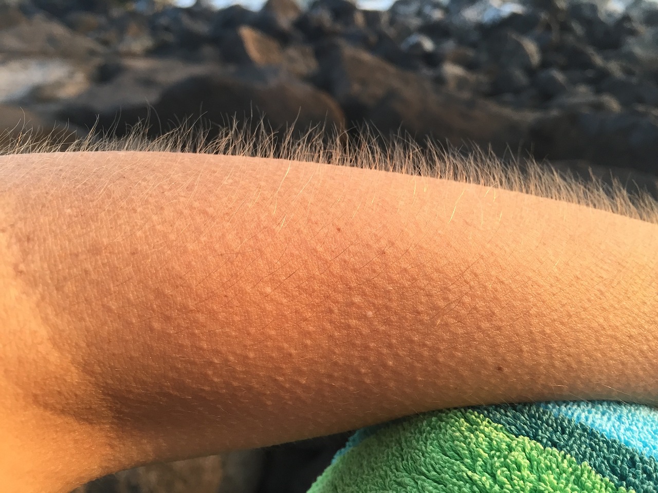 모공 각화증 치료