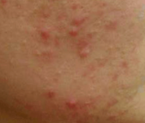 화농성 여드름 주의사항과 부작용