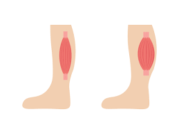 종아리 근육 통증 원인