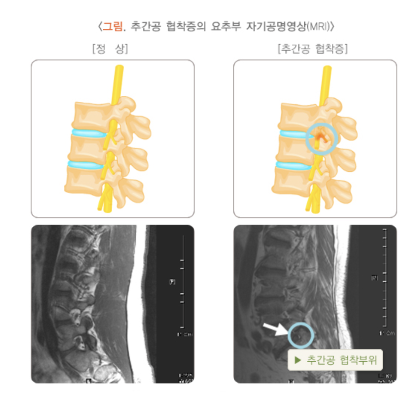 척추관협착증 증상 10가지 총정리 섬네일