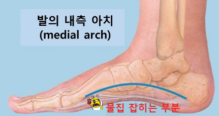 아치물집이슈