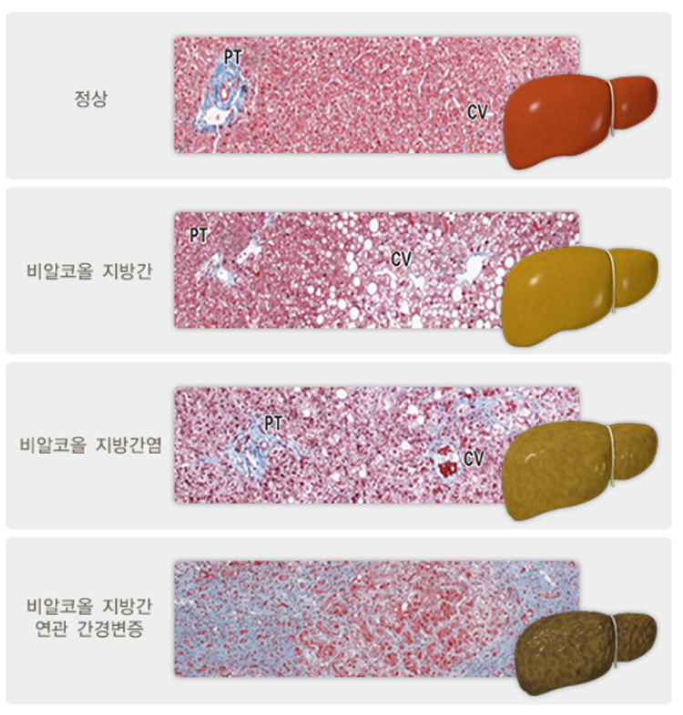 지방간에 좋은 음식