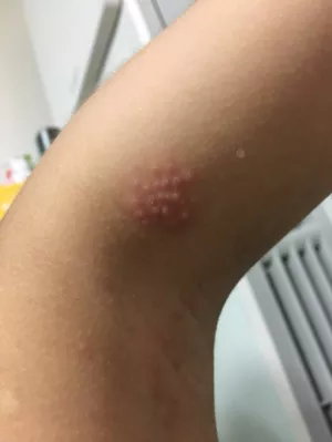 대상포진 증상