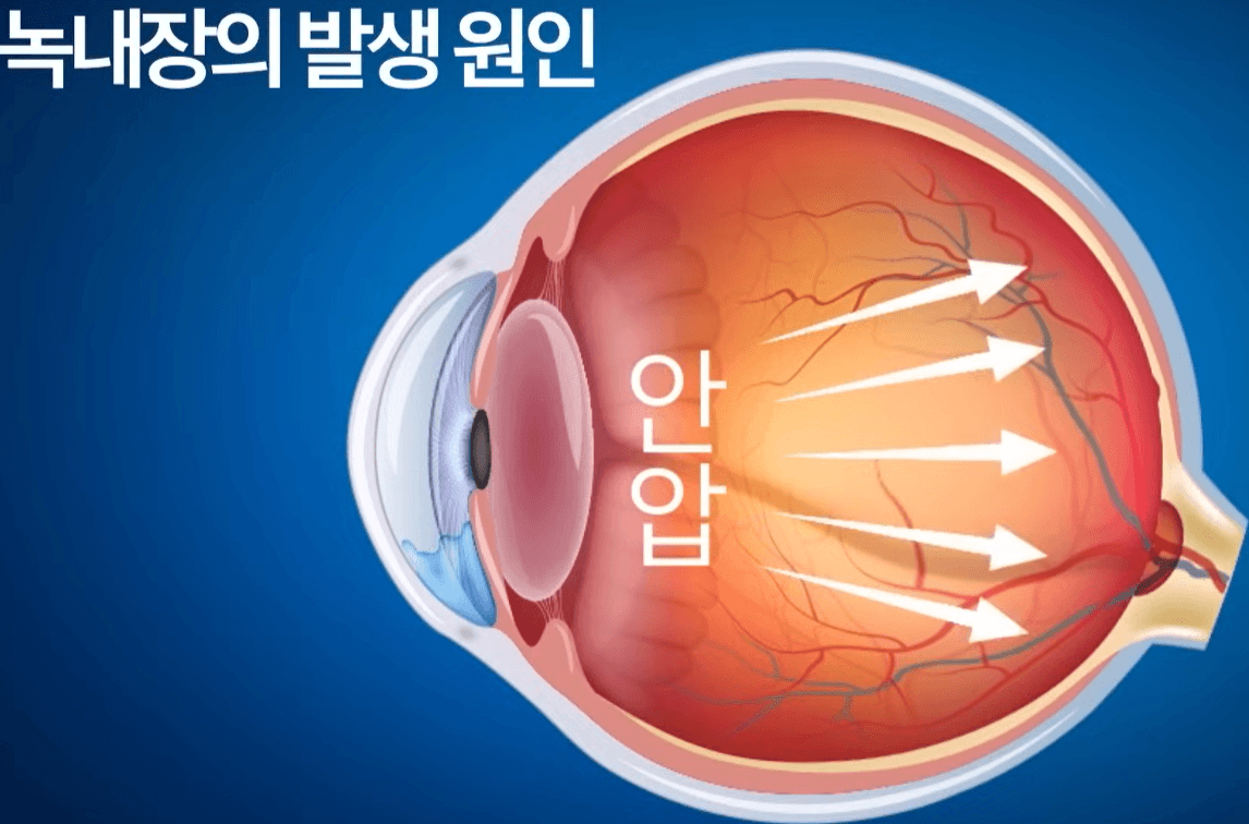 녹내장 발생원인