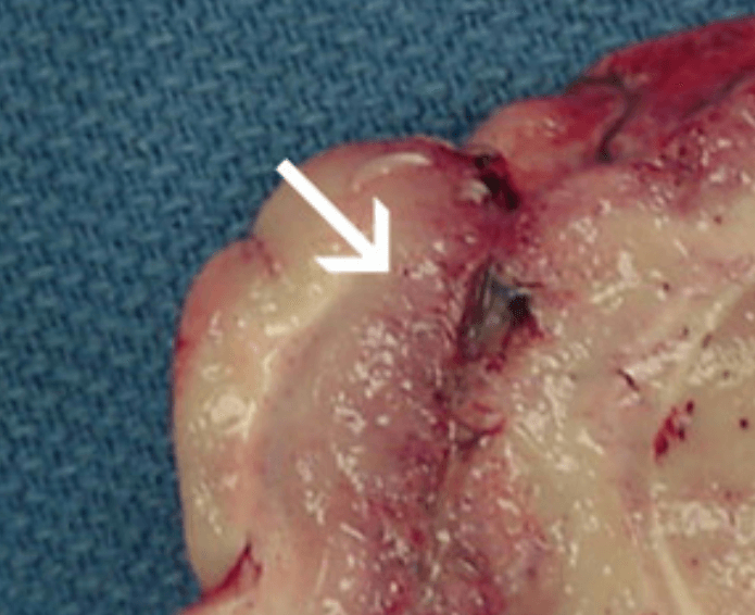 미국 뇌 먹는 아메바 네글레리아 파울러리 감염 후 뇌의 모습