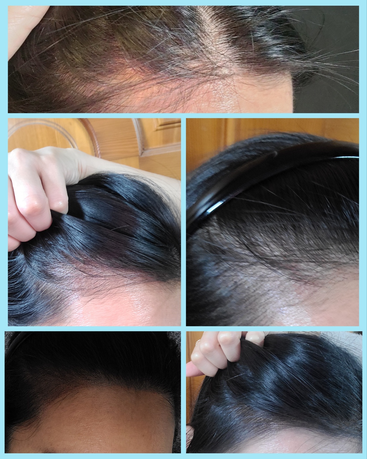 콤마더문 강남점 SMP두피문신 오른쪽 헤어라인 변화