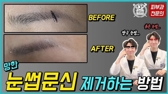 눈썹 문신 제거 방법 꿀팁_1