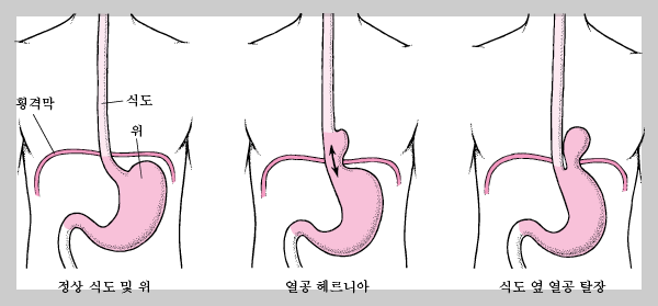 역류성식도염 증상과 원인, MSD참조