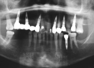 임플란트 수술 후 관리법