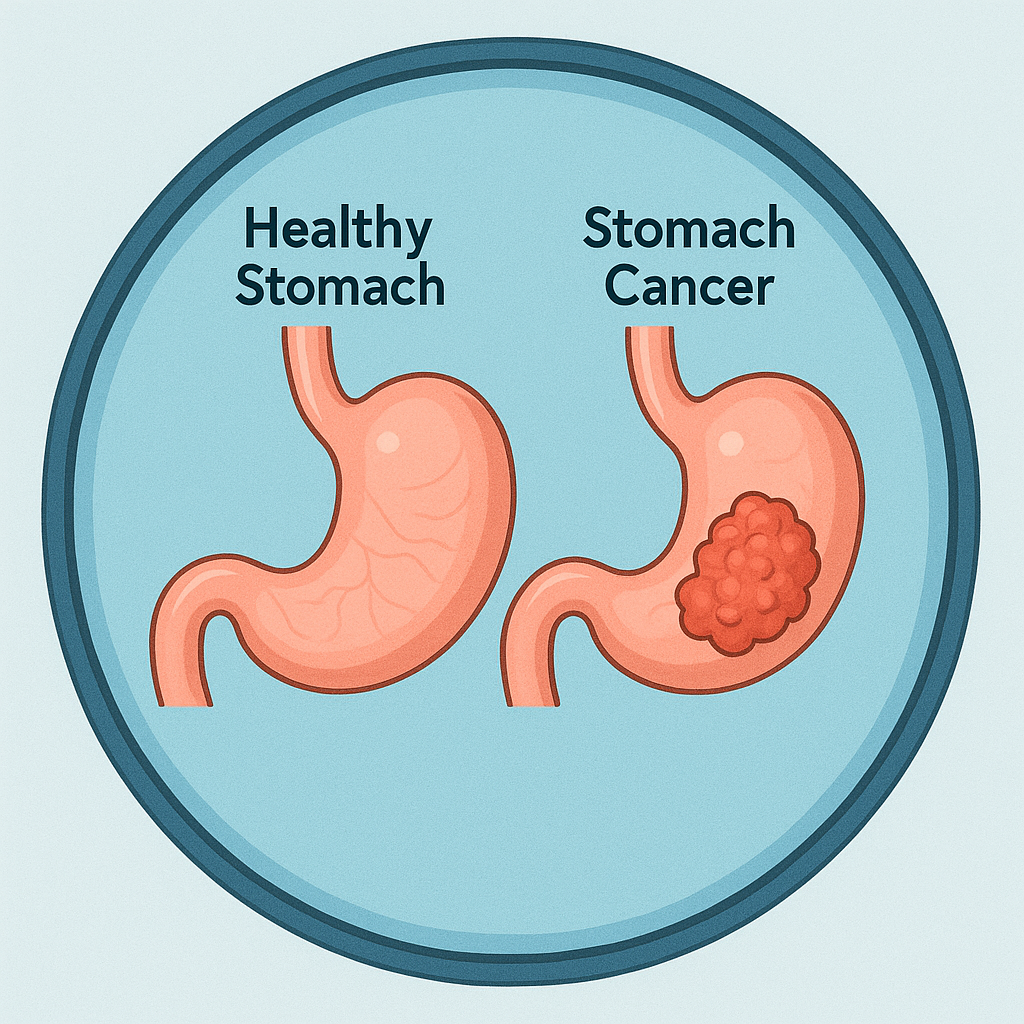 (건강한위와 위암)