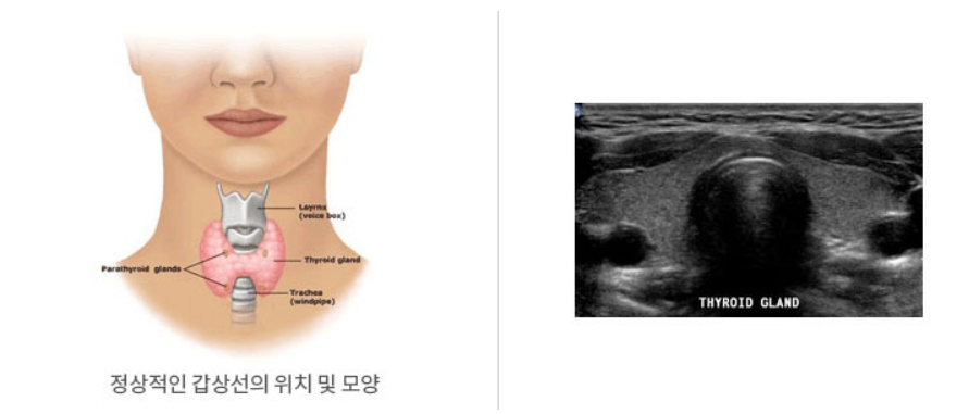 갑상선 기능 항진증 증상, 원인, 검사, 좋은 음식