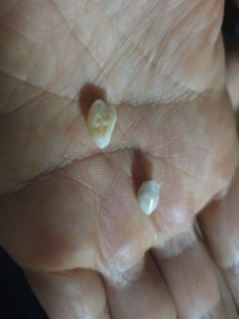 빠진-이-두개를-손바닥에-올려놓고-보고있는-모습