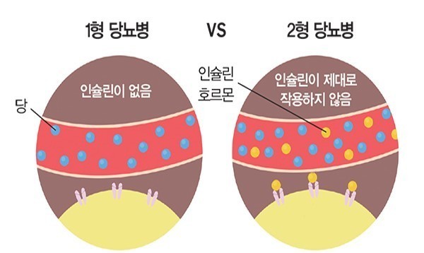 당뇨병 초기증상