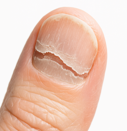 손톱이 갈라지고 들뜬 모습