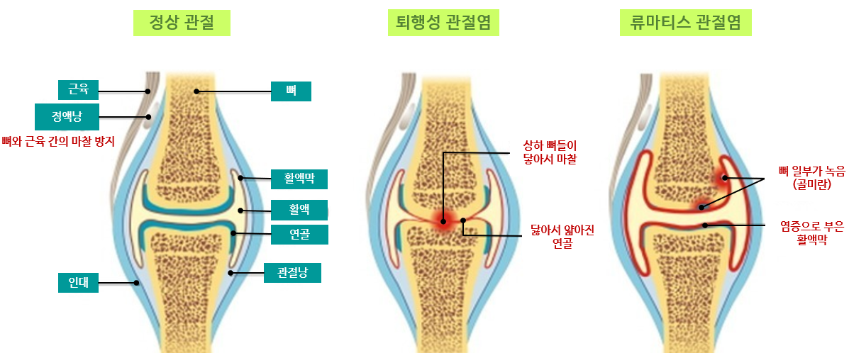 정상관절과 관절염