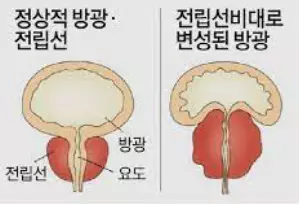 방광염-증상-건강