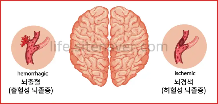 뇌졸중-전조증상-체크리스트