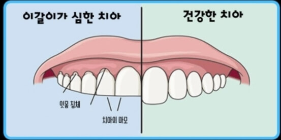 이갈이-심한-사진