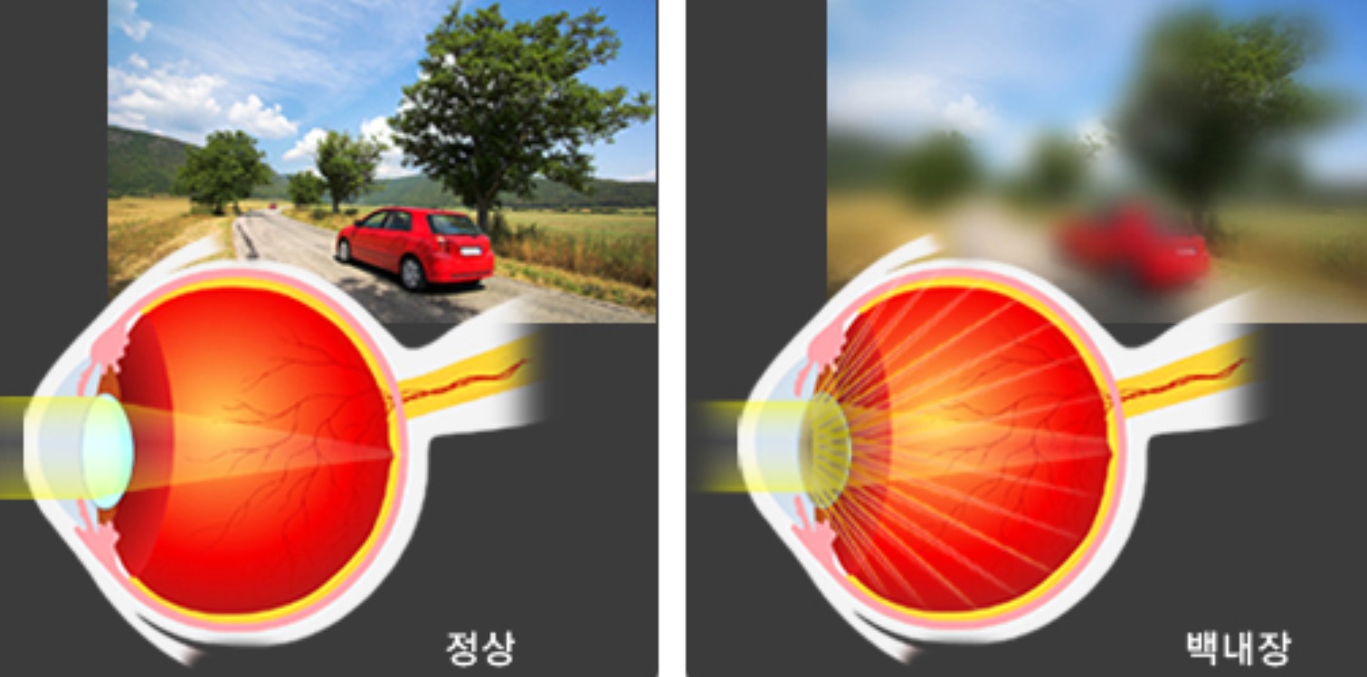 백내장 초기증상-정상인과 백내장 환자의 눈