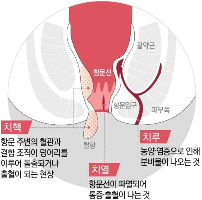 치질증상