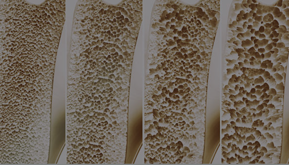 골다공증과 관련된 사잔2