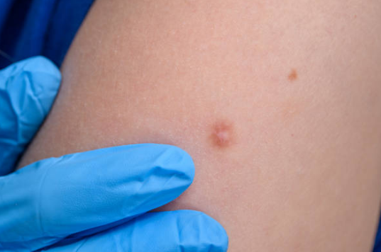 쥐젖 제거방법, 쥐젖이 생기는 이유, 제거 연고 총정리 (2024ver)