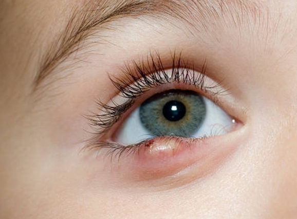 다래끼 원인 종류 빨리낫는법 눈다래끼 초기증상 치료 전염 찜질