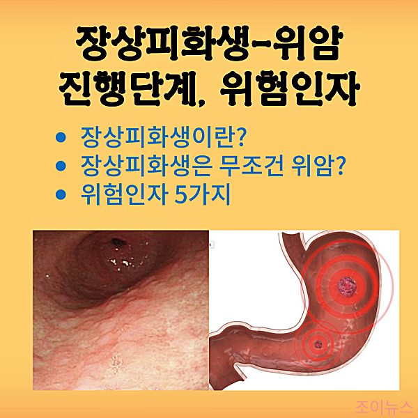 장상피화생이 암으로 가는 진행단계, 위암 촉진요인 5가지 예방하기