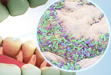 불결한 구강위생